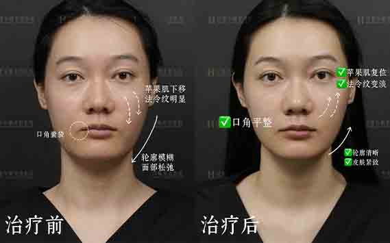 羟基玻尿酸案例